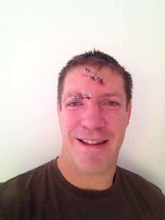 botha suture